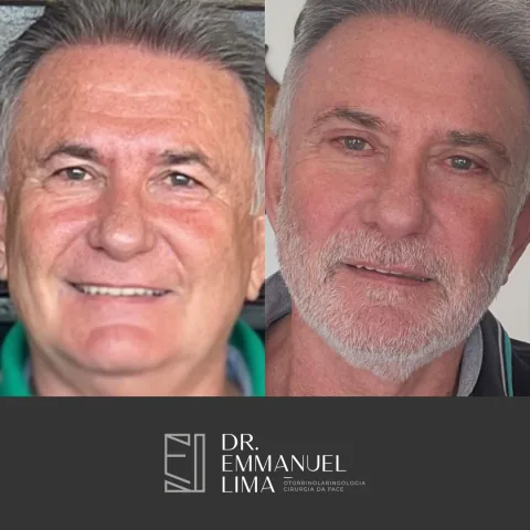 Blefaroplastia completa