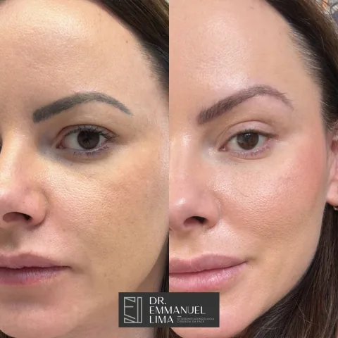 Blefaroplastia superior