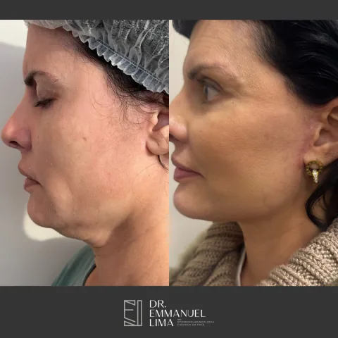 Lifting facial e cervical